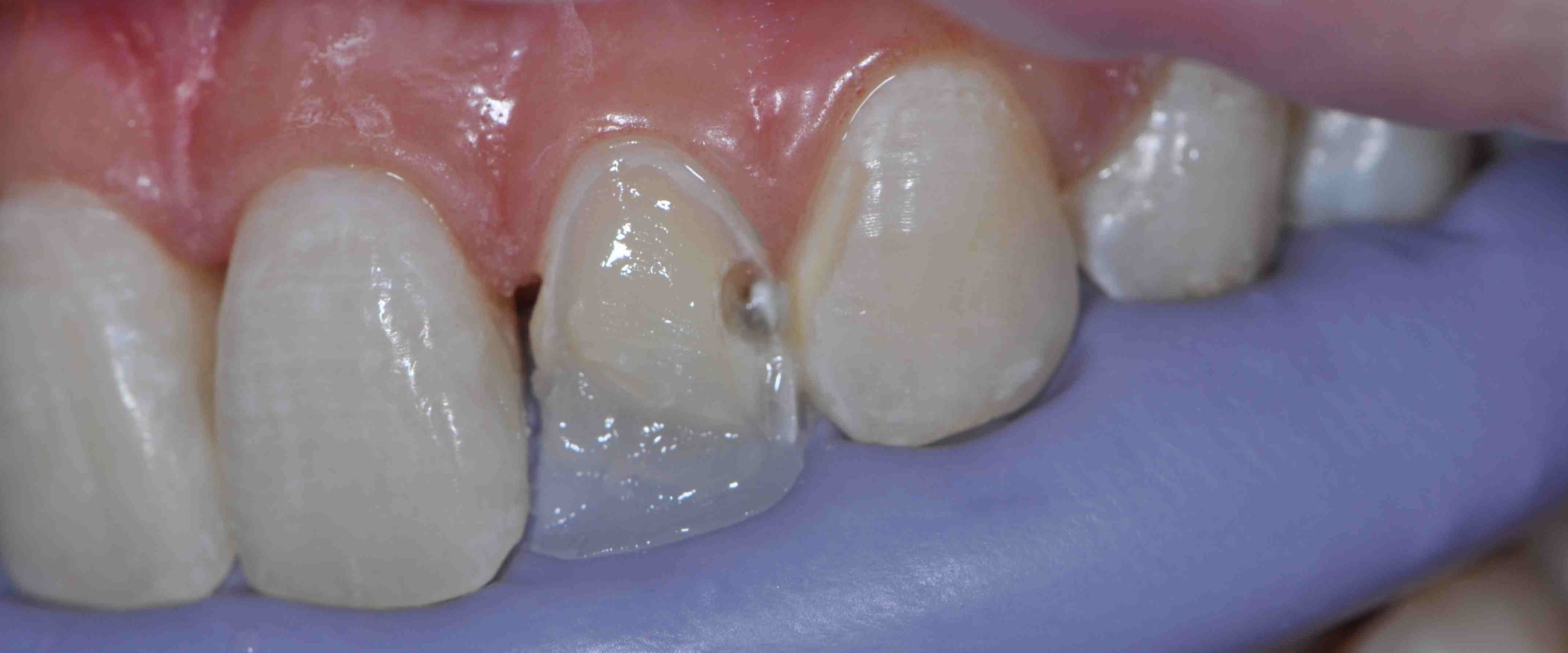 Preparing a Composite for Staining