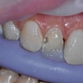 Preparing a Composite for Staining